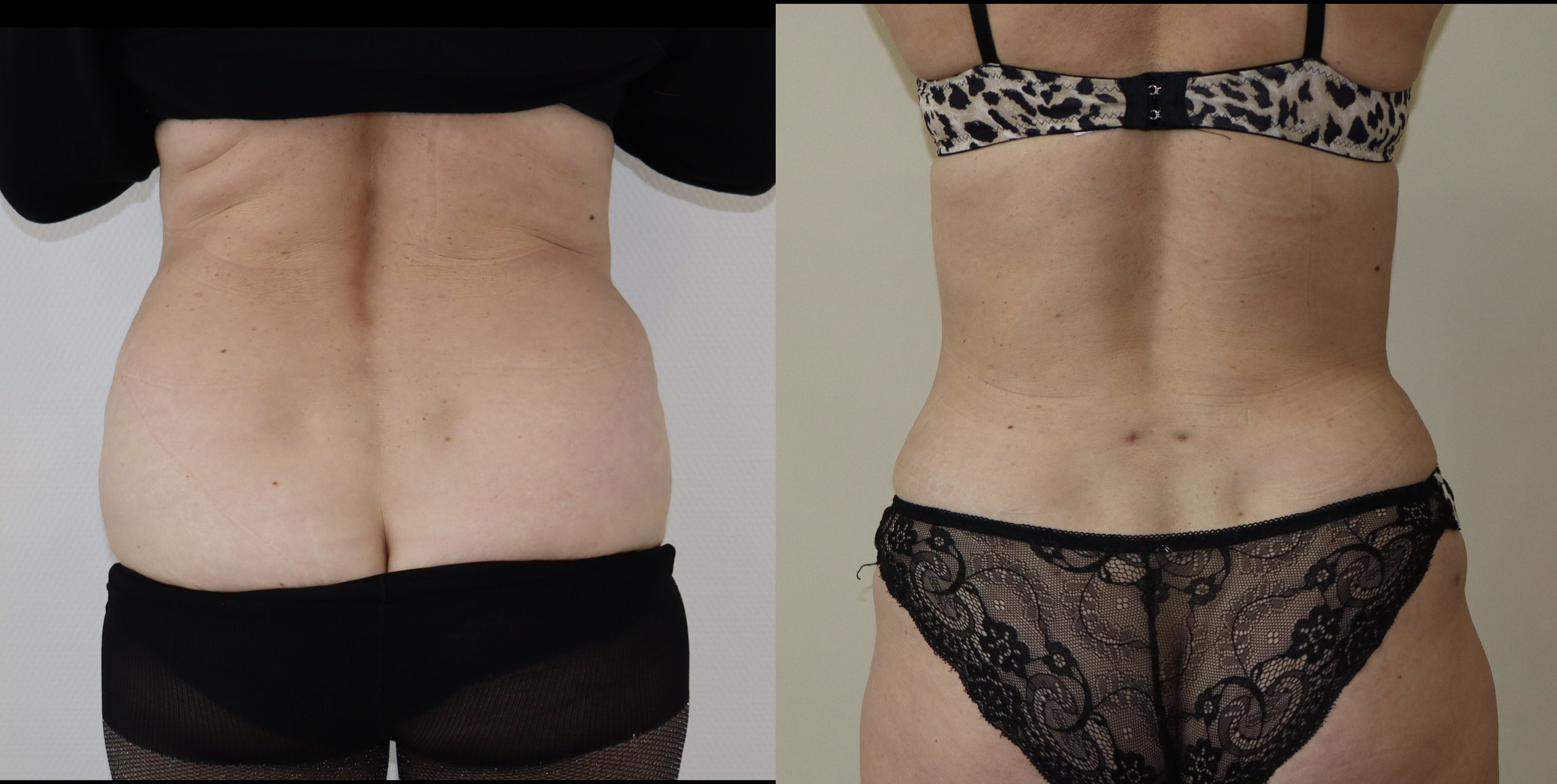 Avant/Après lipoaspiration flancs abdomen